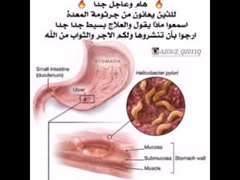 ما اضرار جرثومة المعده إسألنا